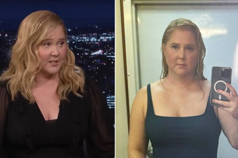 Amy Schumer says 'moon face' trolling led her to rare hormonal diagnosis