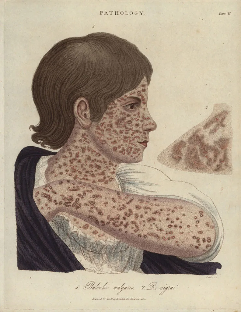 Stay Safe: Protect Yourself and Your Family from Measles