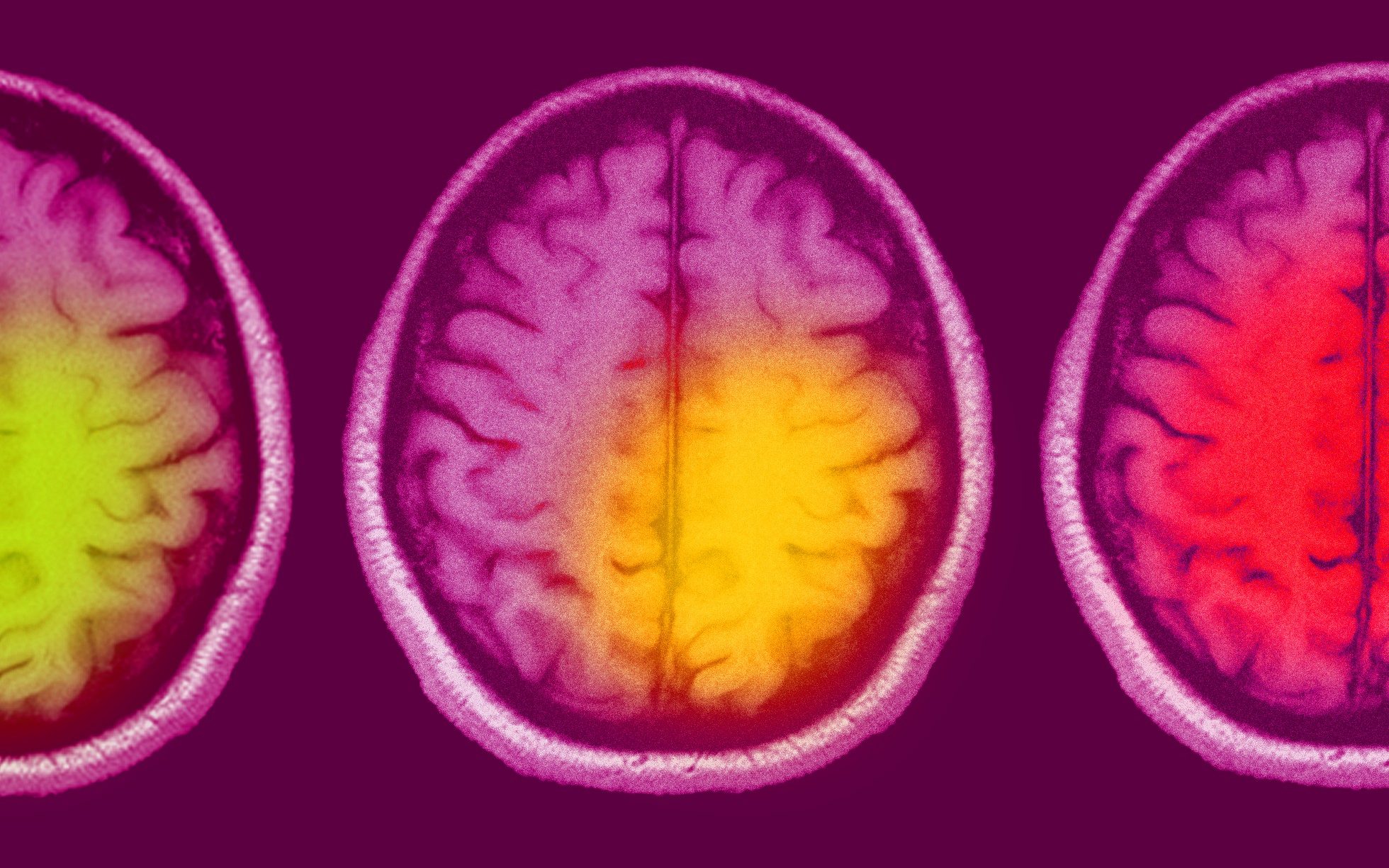 brain ageing