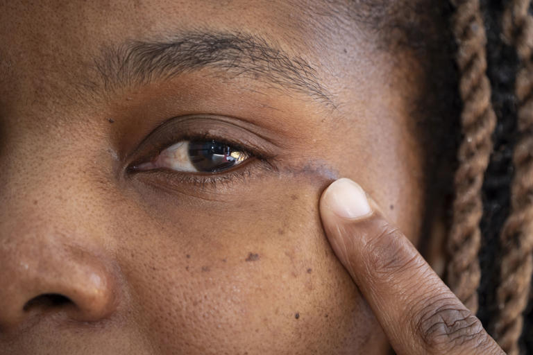 A small scar at the corner of Ruvimbo Kaviya’s eye after she received the surgery (Danny Lawson/PA) (PA Wire)