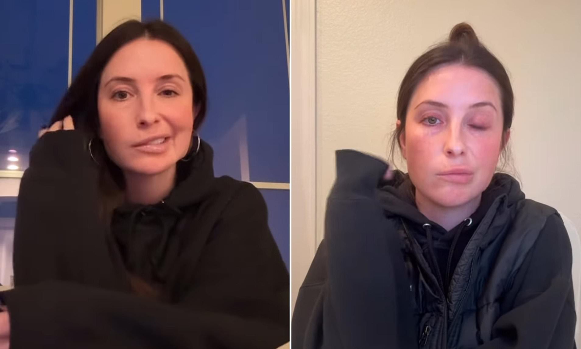 Teen Mom star Bristol Palin reveals facial paralysis caused by stress
