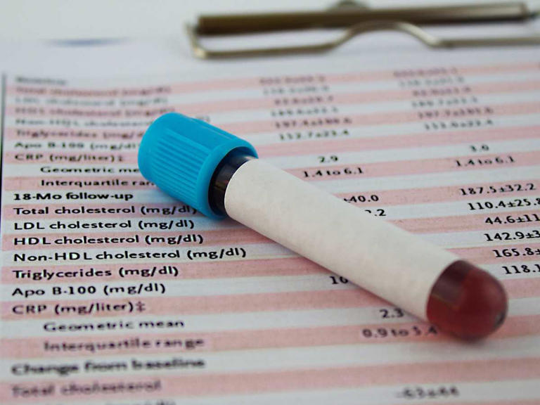 Qué es una química sanguínea y qué significan sus elementos | Getty Images