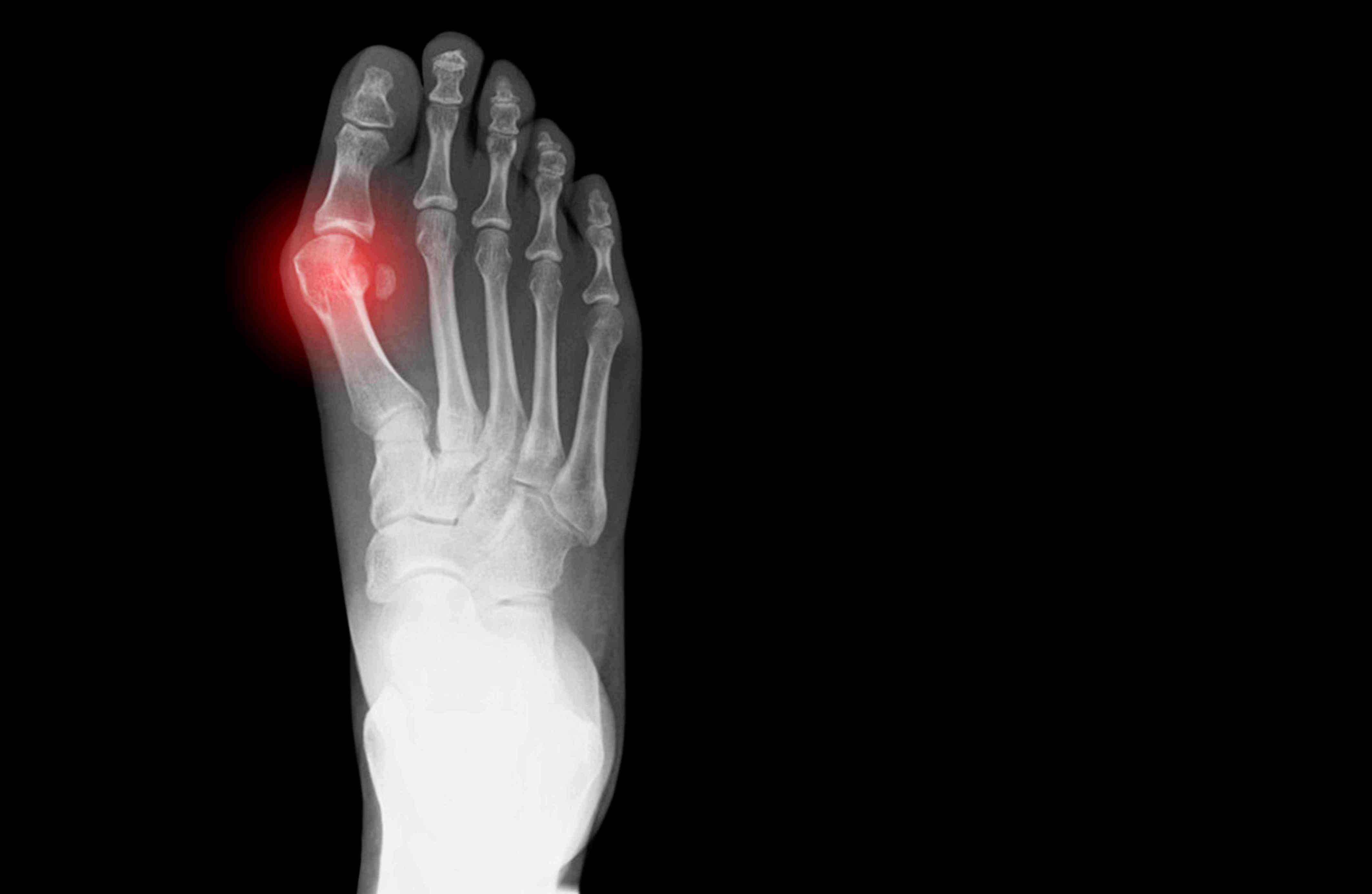 4 common toe problems that make feet look abnormal