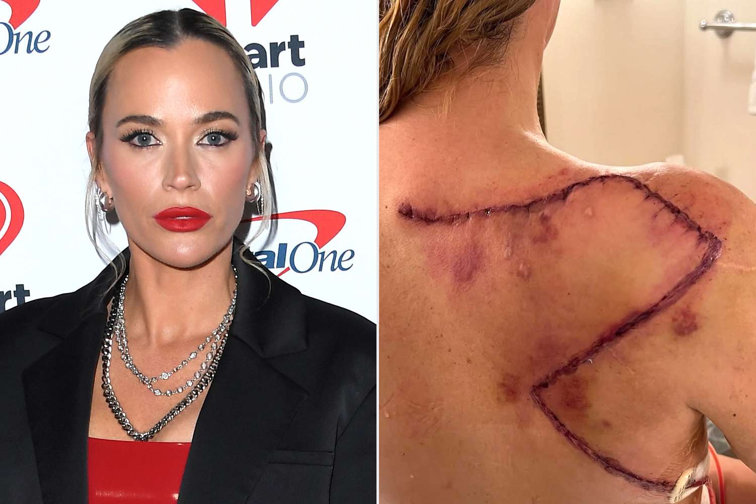 Teddi Mellencamp Reshares Graphic Image of Surgery Scar for World
