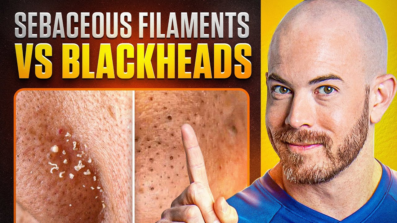 Sebaceous Filaments vs. Blackheads Understanding Differences and