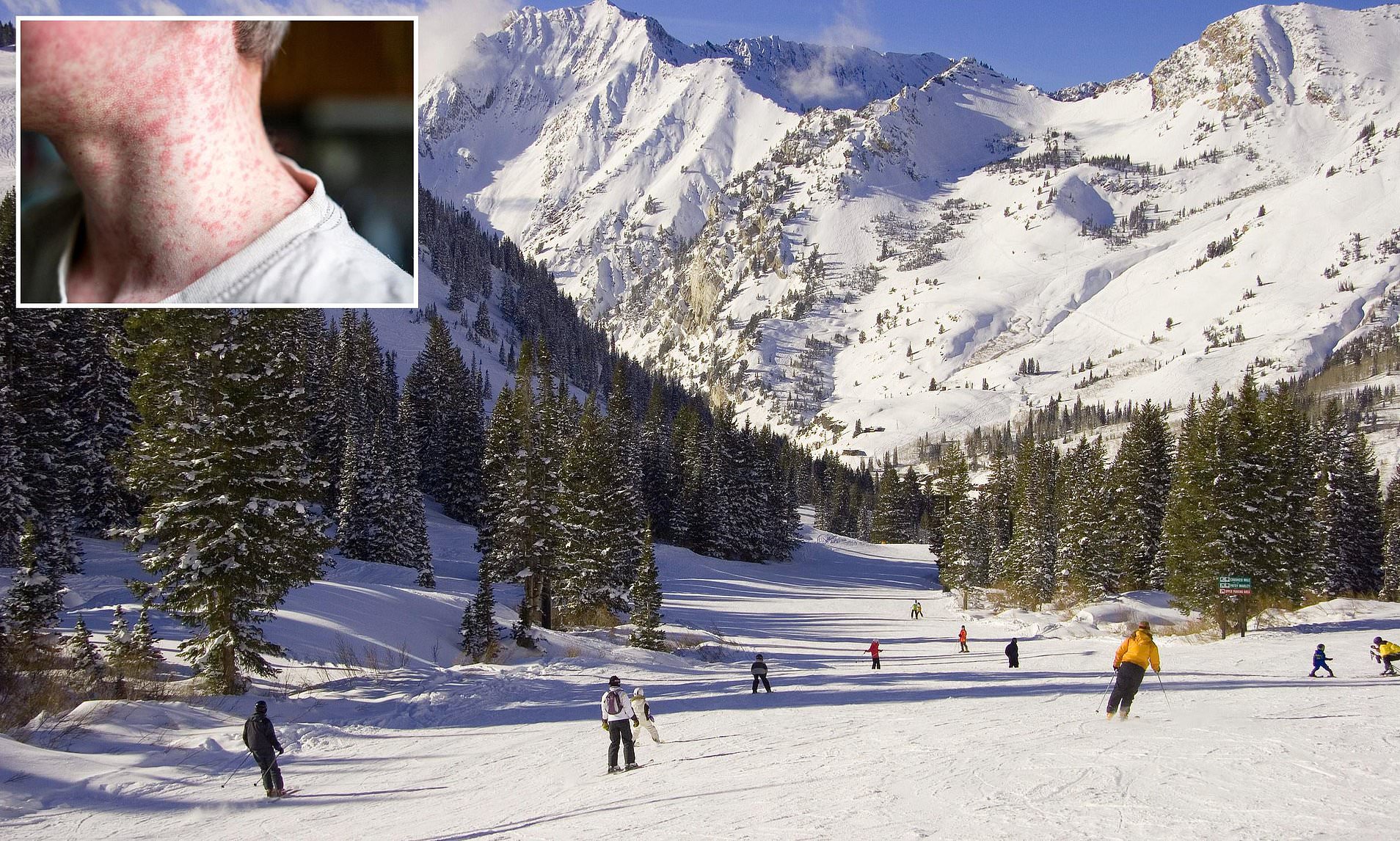 Measles cases surging at Europe&rsquo;s ski resorts