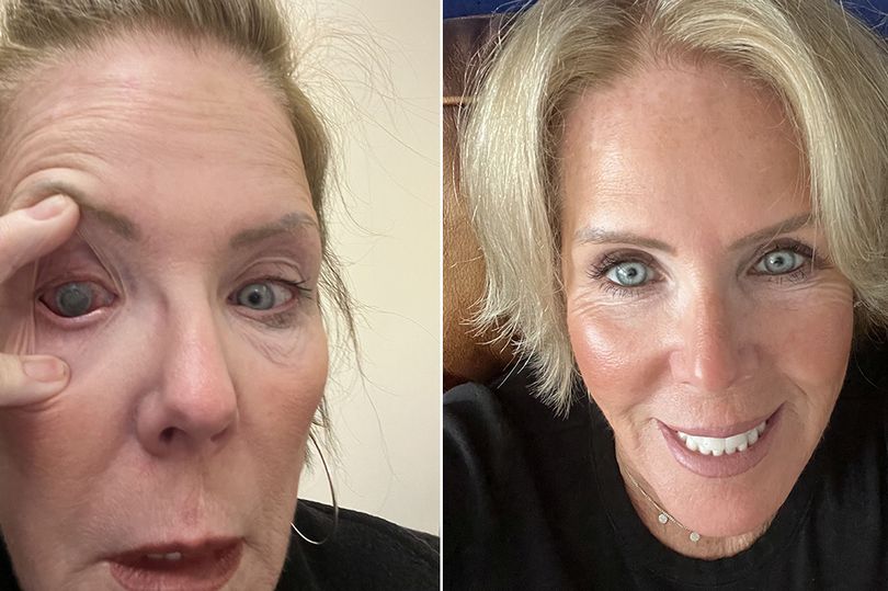 Lifeguard left blind as parasite burrows into her eye after wearing