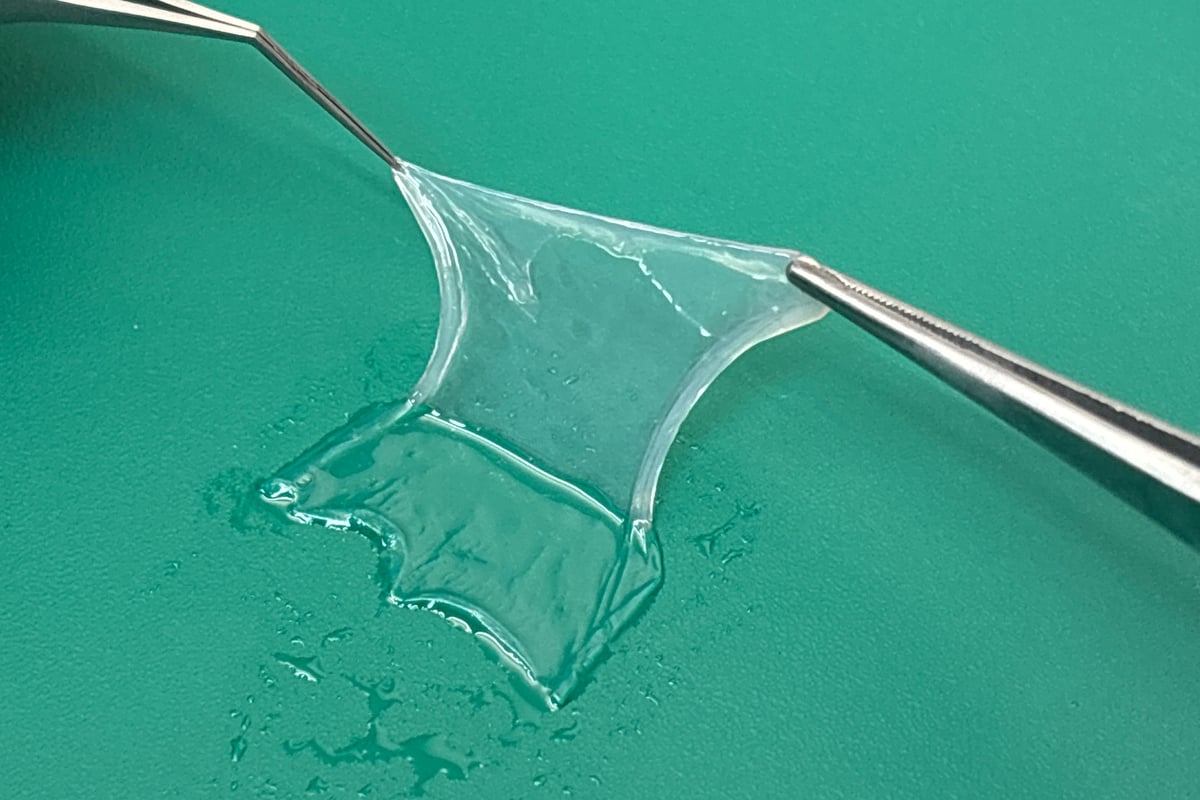 Acid attack victim has eye saved by donated placenta