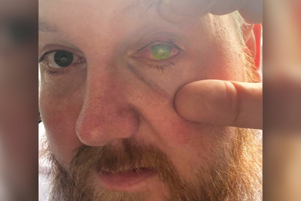 Donated placenta saves acid attack victim’s eye