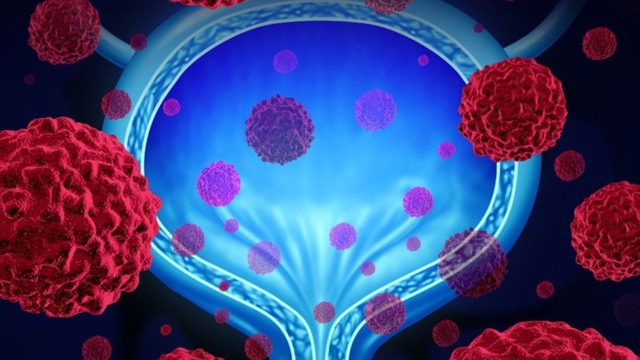 Urinary metabolites signal bladder cancer risk and recurrence in new ...