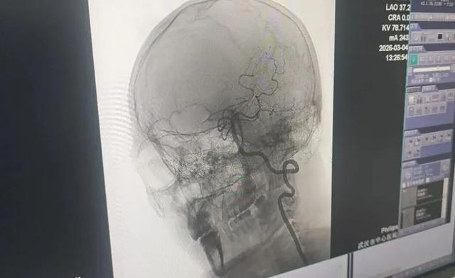 Đột quỵ ở tuổi 33 sau khi đi massage cổ vai gáy