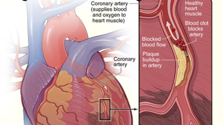 24 and dying from a rare heart condition, then this device saved her life