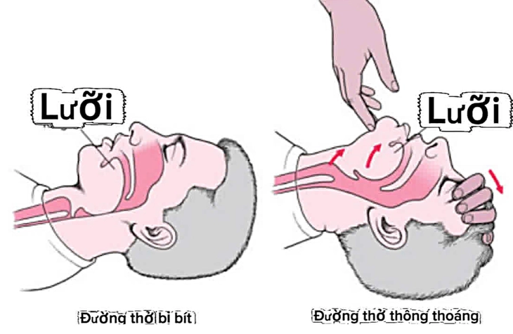 Đừng kéo lưỡi khi cấp cứu 'nuốt lưỡi'
