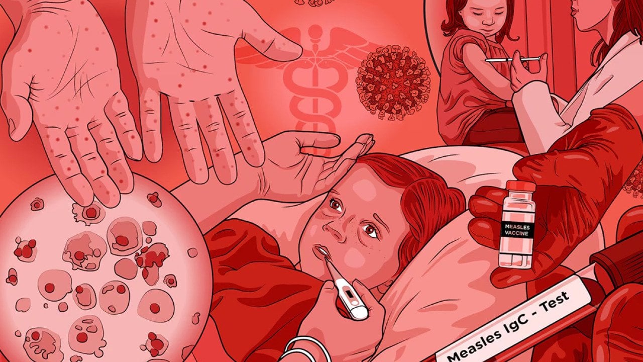 Michigan measles outbreak shows high cost of stopping even a small ...
