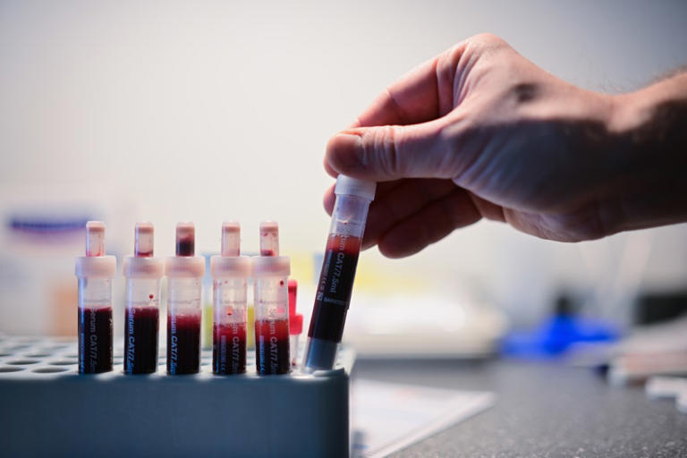Simple blood test may predict dementia risk before symptoms even appear