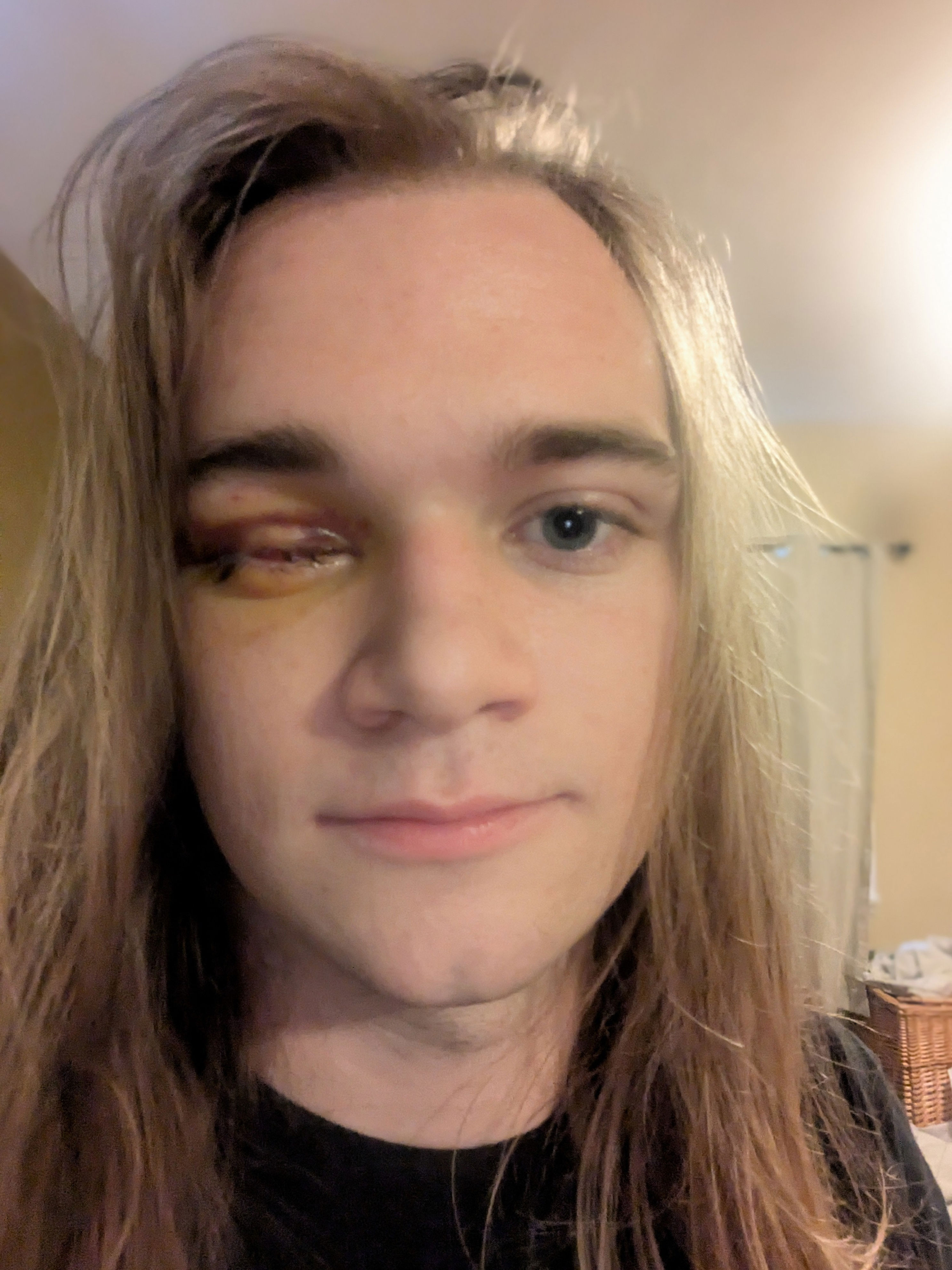 Teen who lost his eye after DHS shot him files civil rights complaint