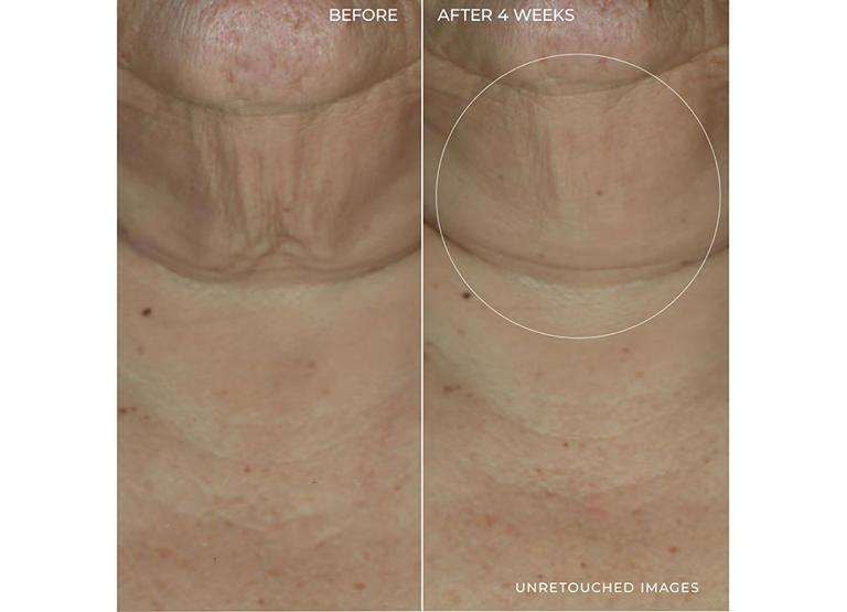 Derms say this skincare stick is the fastest way to correct chest and ...