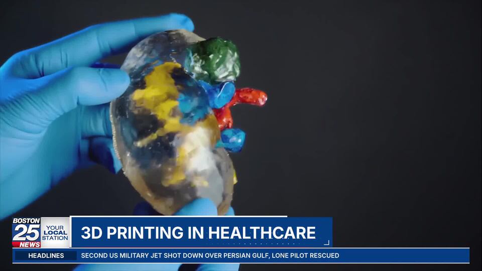 Local 3D printer company helping hospitals improve patient care