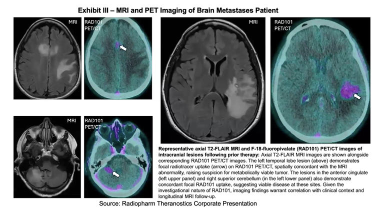 RADX: RAD 101 phase IIb interim analysis