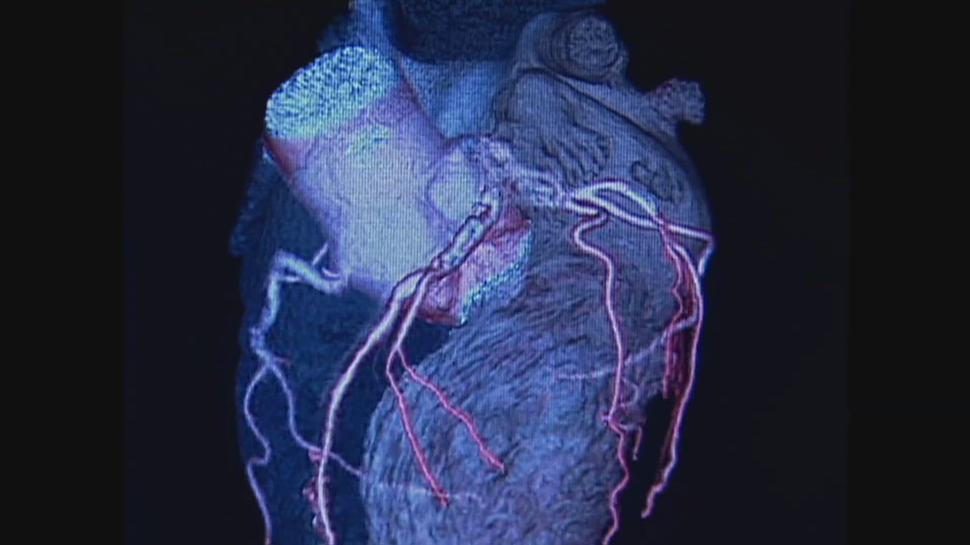 New heart disease guidelines focus on earlier risk detection, lower ...