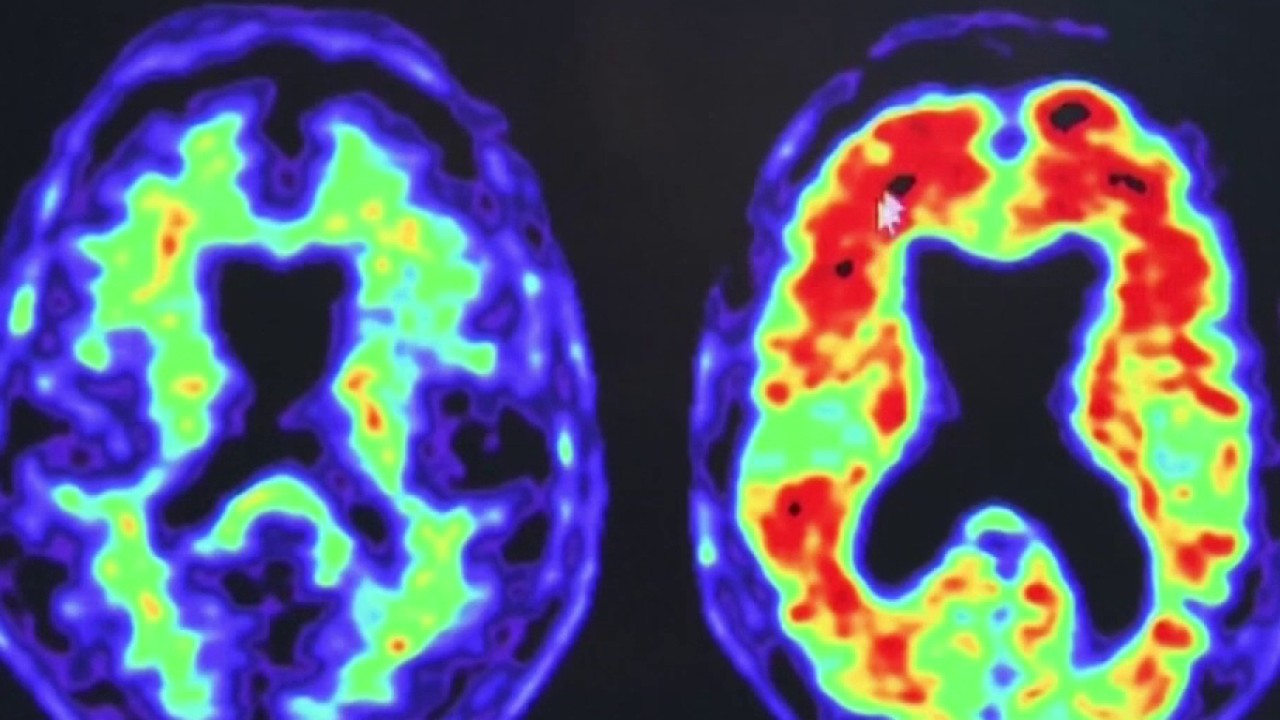 Your sleep may reveal early signs of dementia risk, study finds