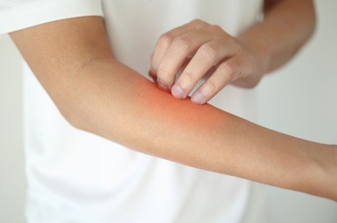 person with red itchy skin