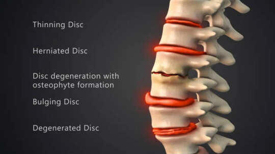 Slipped disc warning: The back pain symptom you should never ignore