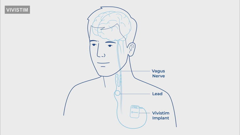 First Nebraska patient receives new implant for stroke recovery