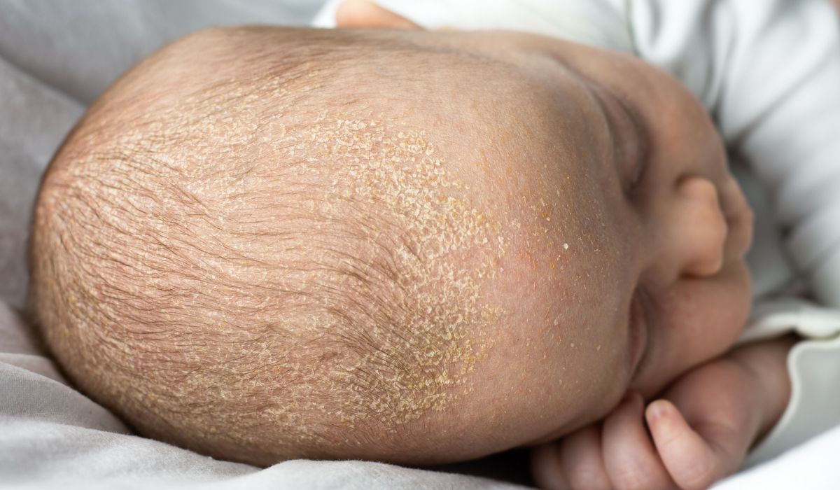 One mum finds a surprising way to get rid of her baby’s cradle cap