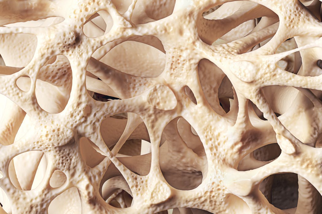 Osteopenia: loss of bone mineral density affects millions of people ...