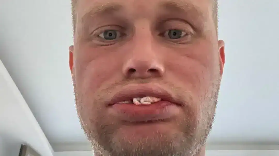 Jon Denton enfrenta desafíos tras tratamiento odontológico fallido en ...