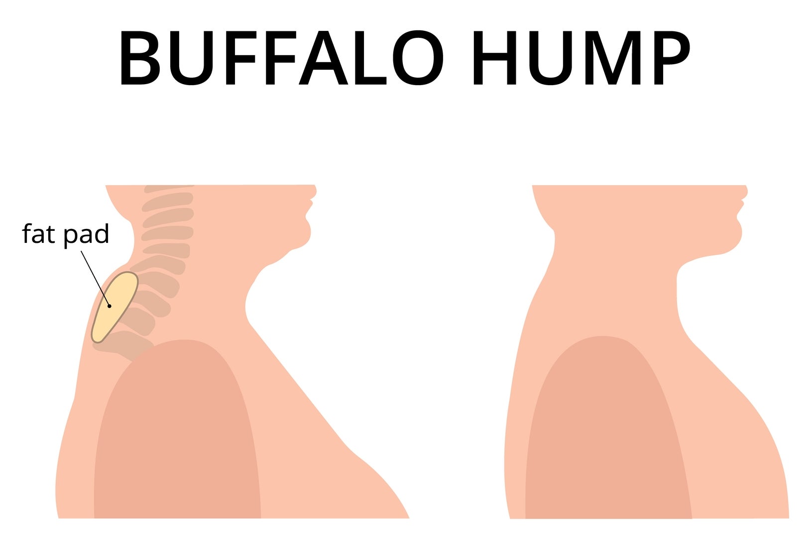 Diagram showing location of a buffalo hump, indicating a fat pad accumulation at the base of the neck, side profile view