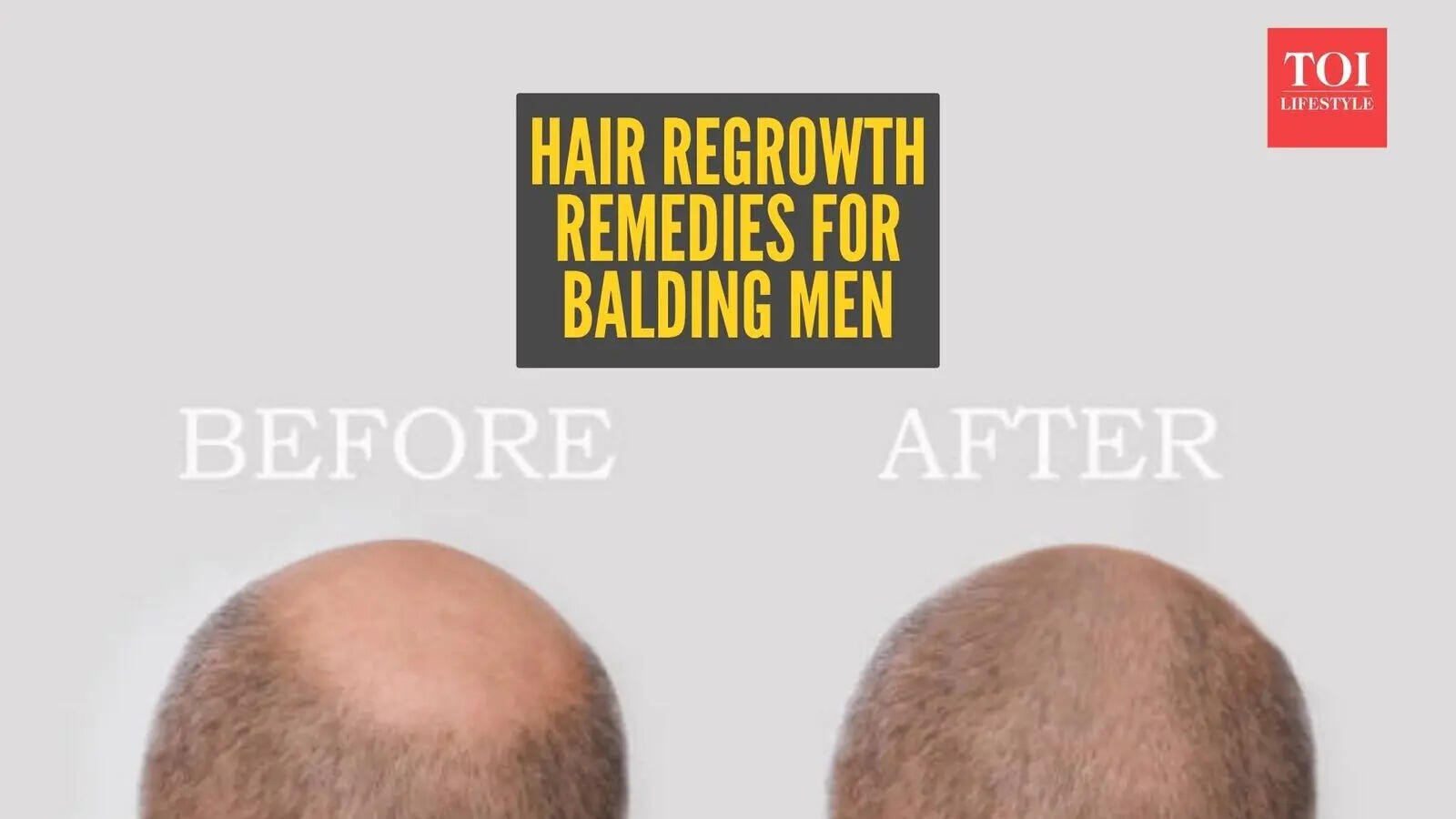 Reverse male pattern baldness: Home remedies for hair regrowth in ...