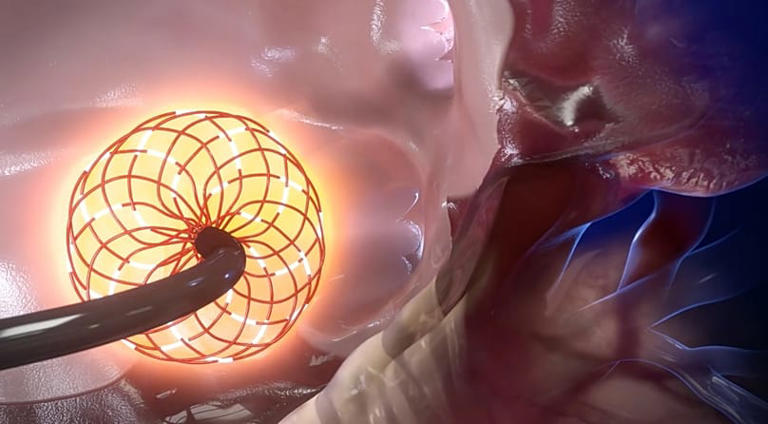 Deep inside the heart: The innovative catheter designed to ...