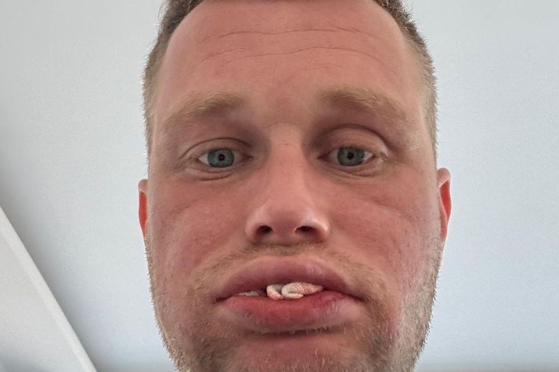 Brit left toothless after £3.5k Turkey teeth fell out while laughing ...