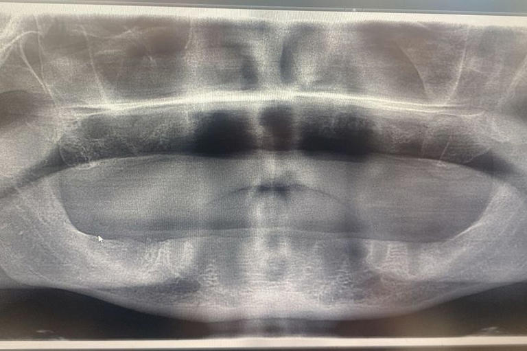 Brit left toothless after £3.5k Turkey teeth fell out while laughing ...
