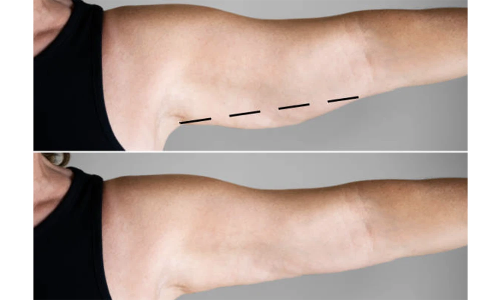 What causes sagging arms and how an arm lift helps