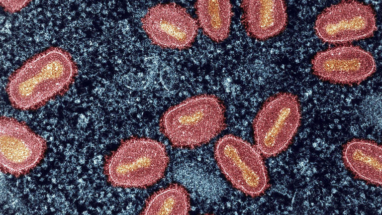 SF Department of Public Health confirms first clade I mpox case