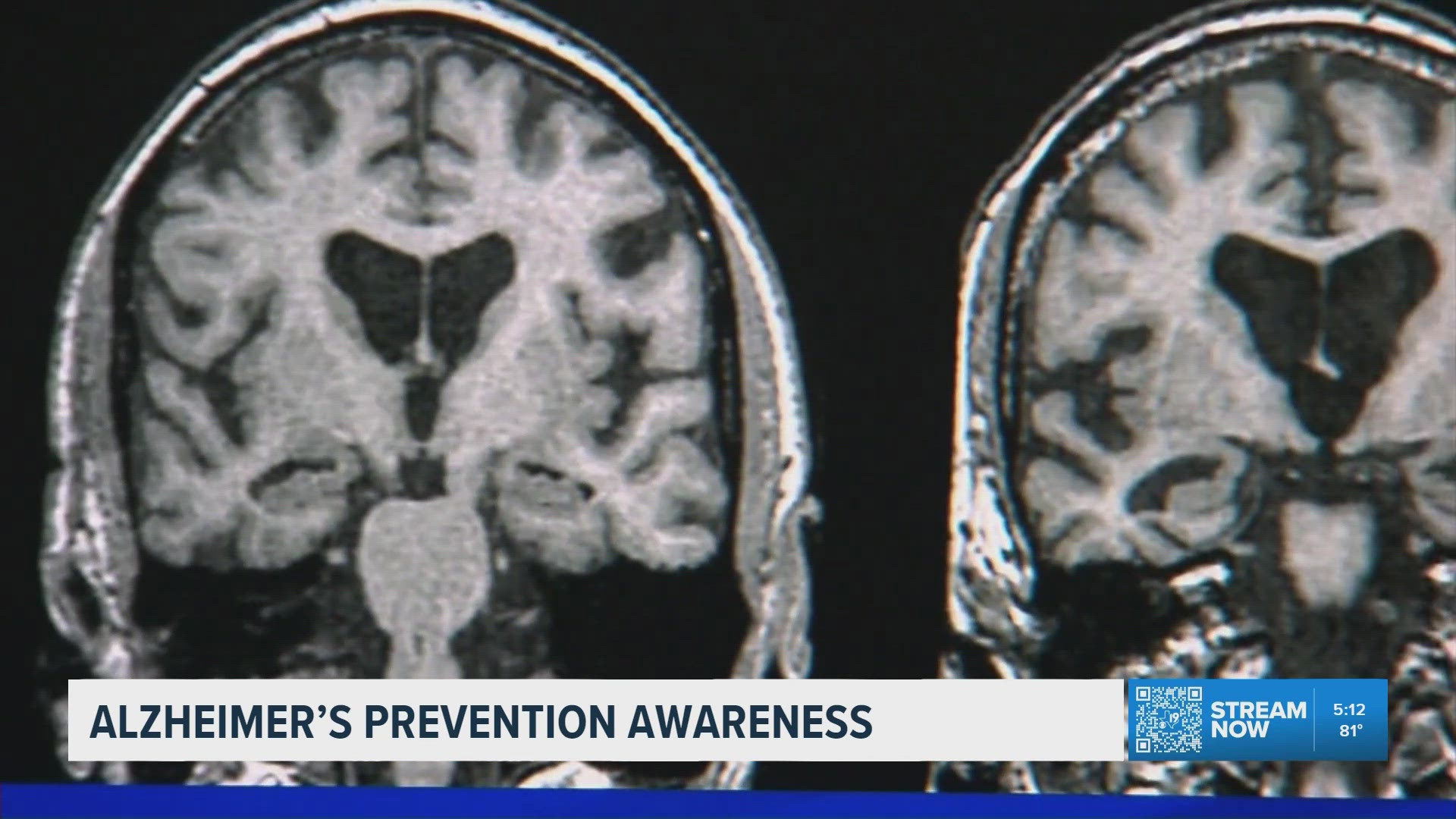 New report highlights habits that may help protect brain health