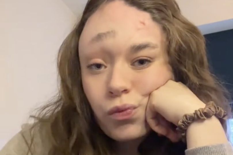 Nurse, 21, with 'two faces' told 'just get surgery' by trolls