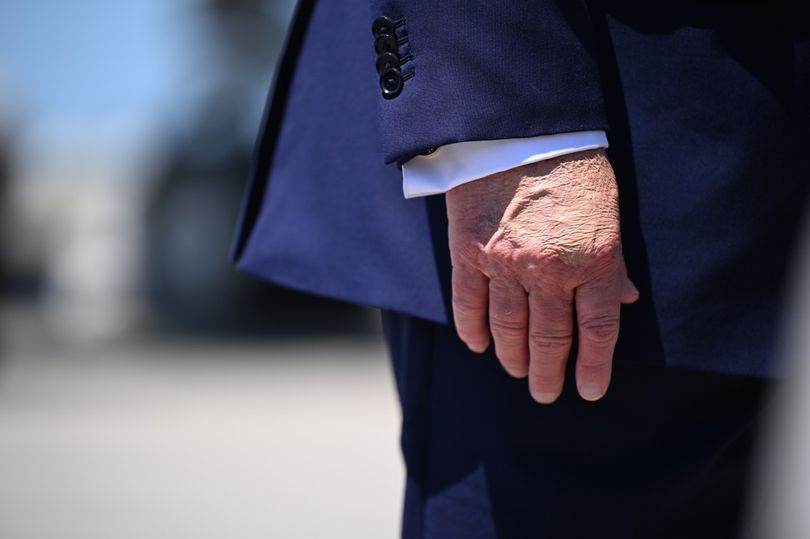Strange mark on Trump's hand sparks health fears as Iran war peace ...