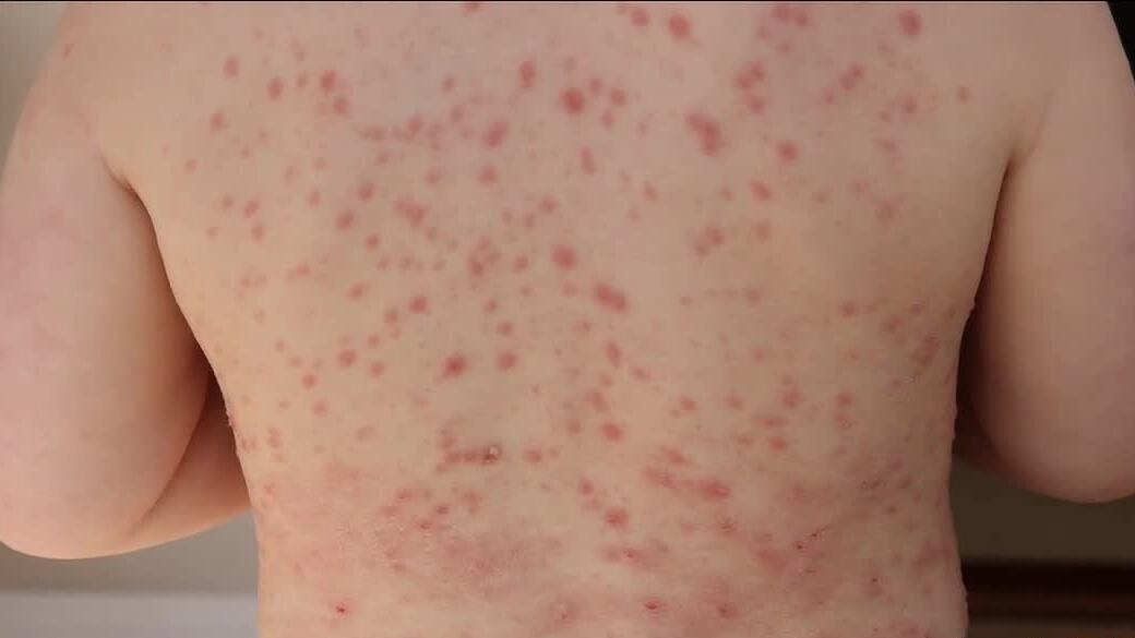 End to Upstate measles outbreak announced