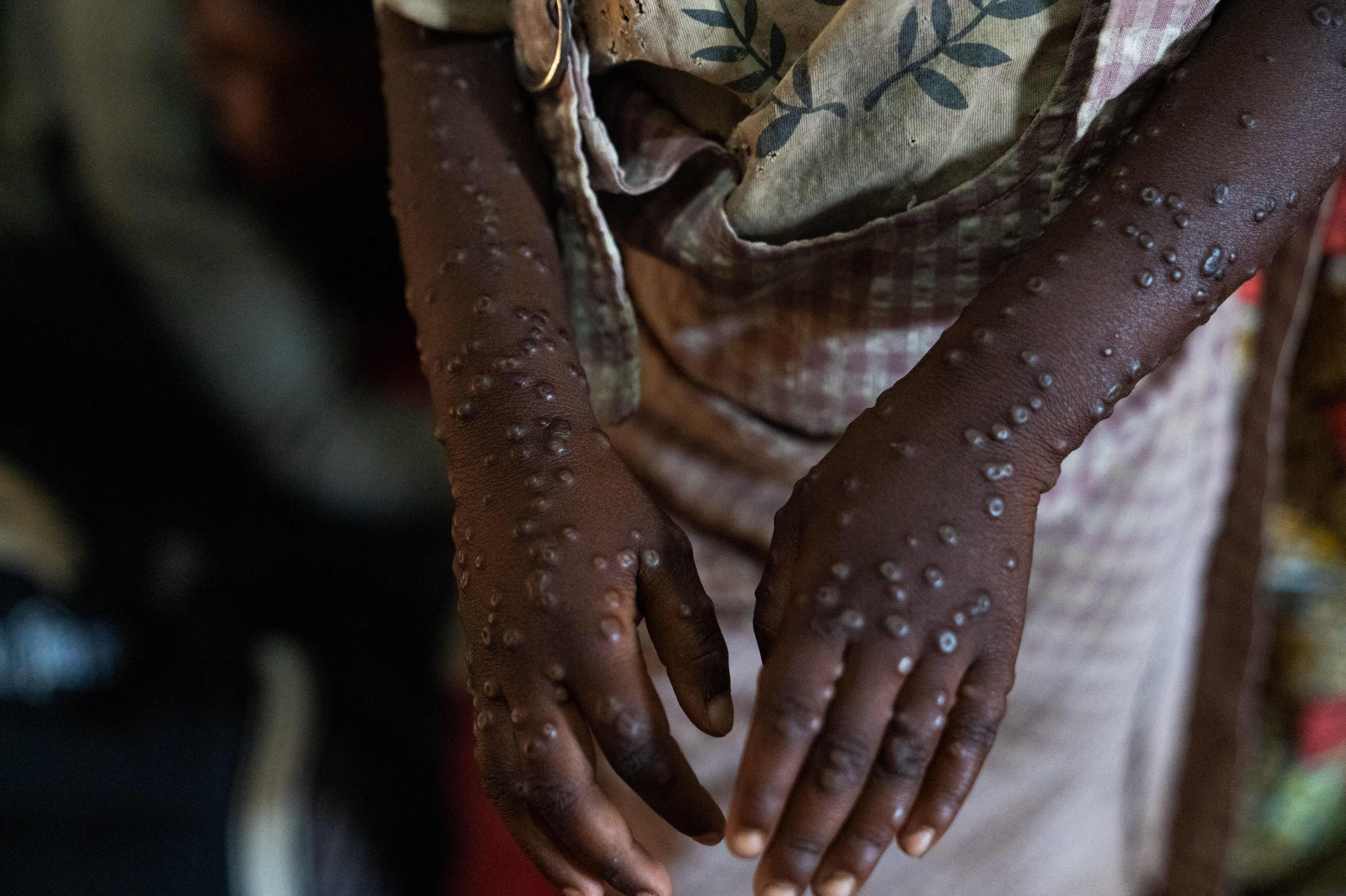Første tilfælde af lokal smitte med MPOX konstateret i Danmark