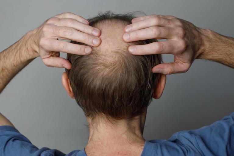 Newly listed Veradermics hair loss drug shows hair growth gains