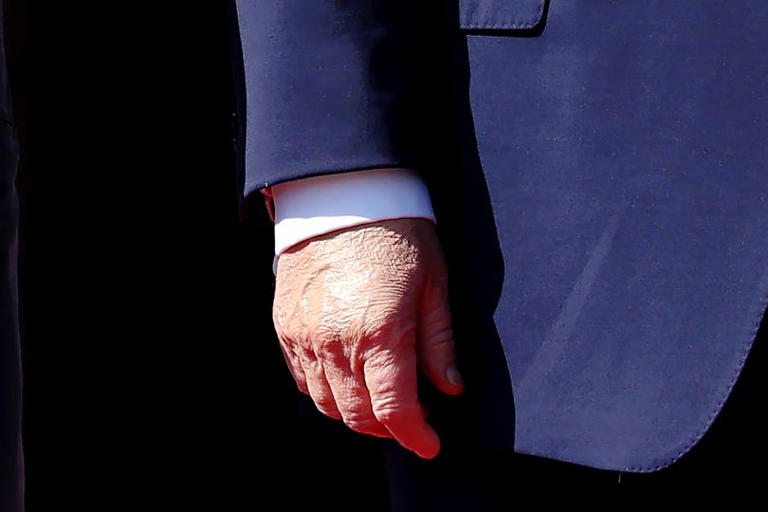 Trump unable to hide swollen and discolored hands during King Charles visit