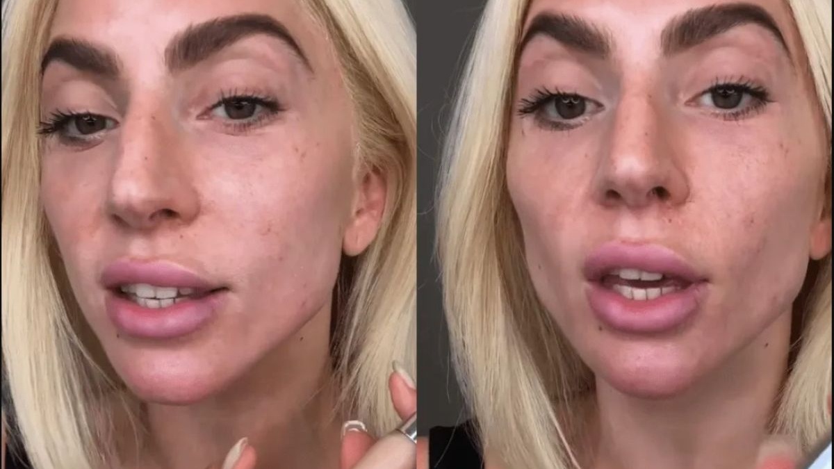 11 celebridades con los síndromes más raros: qué son y cómo cambiaron ...