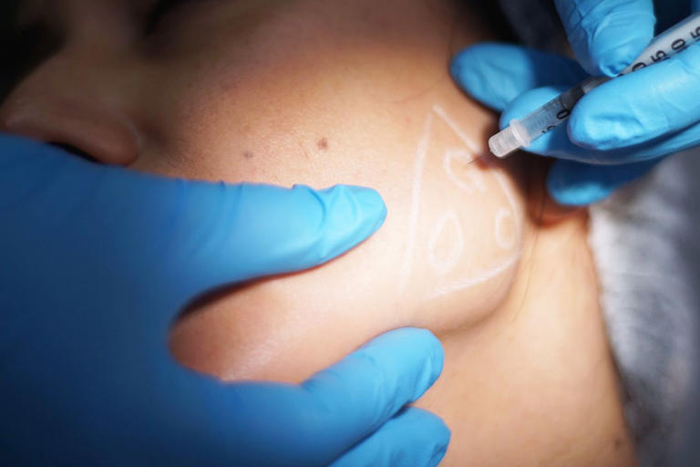 What really happens when a facelift starts 'slipping'? 3 surgeons ...
