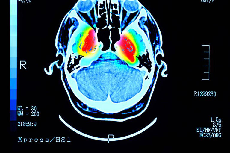Simple midlife habit linked to lower dementia risk - and it’s easier ...