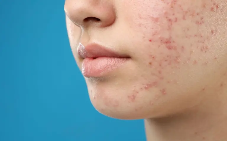 Viral lemon and olive oil skin hack lacks scientific backing