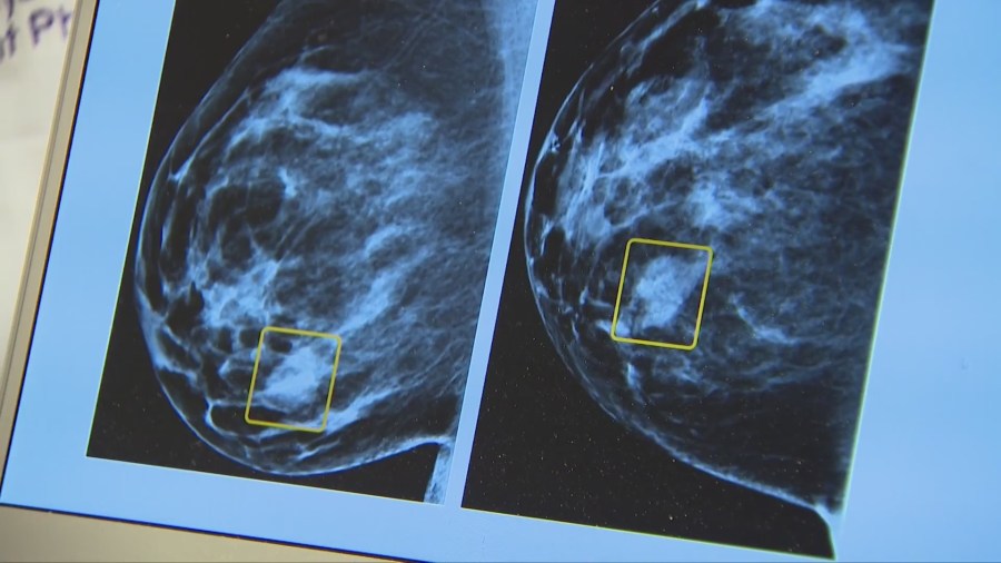 Understanding breast cancer genes – and more health headlines
